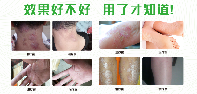 香蕉福利视频真菌清噴劑